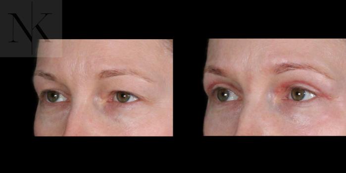 Before & After Upper Blepharoplasty Case 200 Left Oblique View in Wethersfield, Hartford, Nebraska