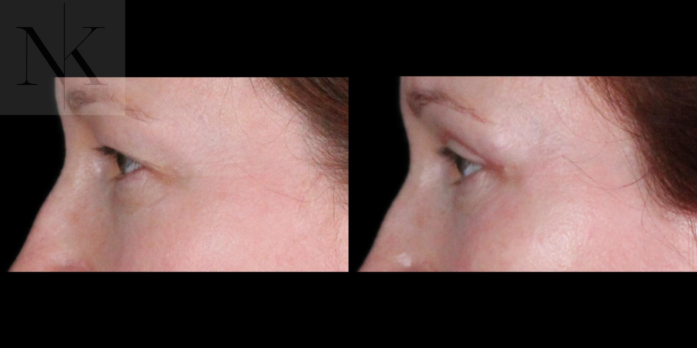 Before & After Upper Blepharoplasty Case 200 Left Side View in Wethersfield, Hartford, Nebraska