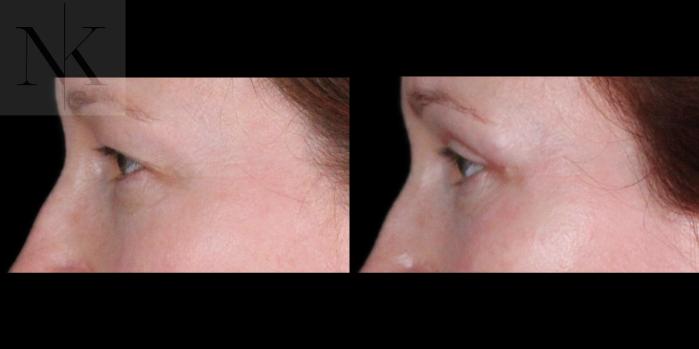 Before & After Upper Blepharoplasty Case 200 Left Side View in Wethersfield, Hartford, Nebraska