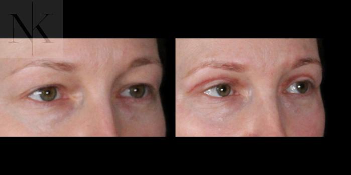 Before & After Upper Blepharoplasty Case 200 Right Oblique View in Wethersfield, Hartford, Nebraska