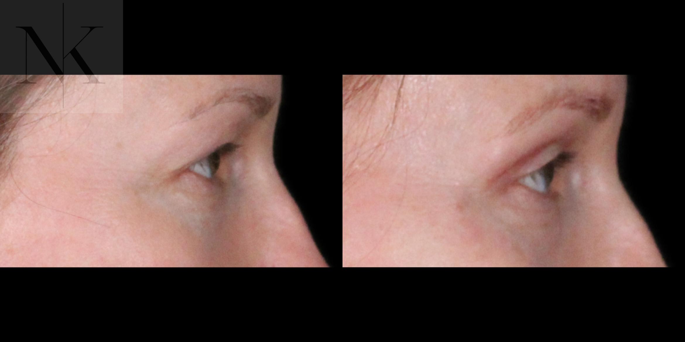 Before & After Upper Blepharoplasty Case 200 Right Side View in Wethersfield, Hartford, Nebraska
