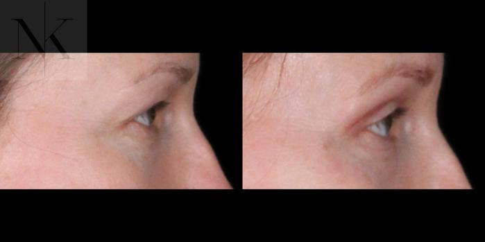 Before & After Upper Blepharoplasty Case 200 Right Side View in Wethersfield, Hartford, Nebraska