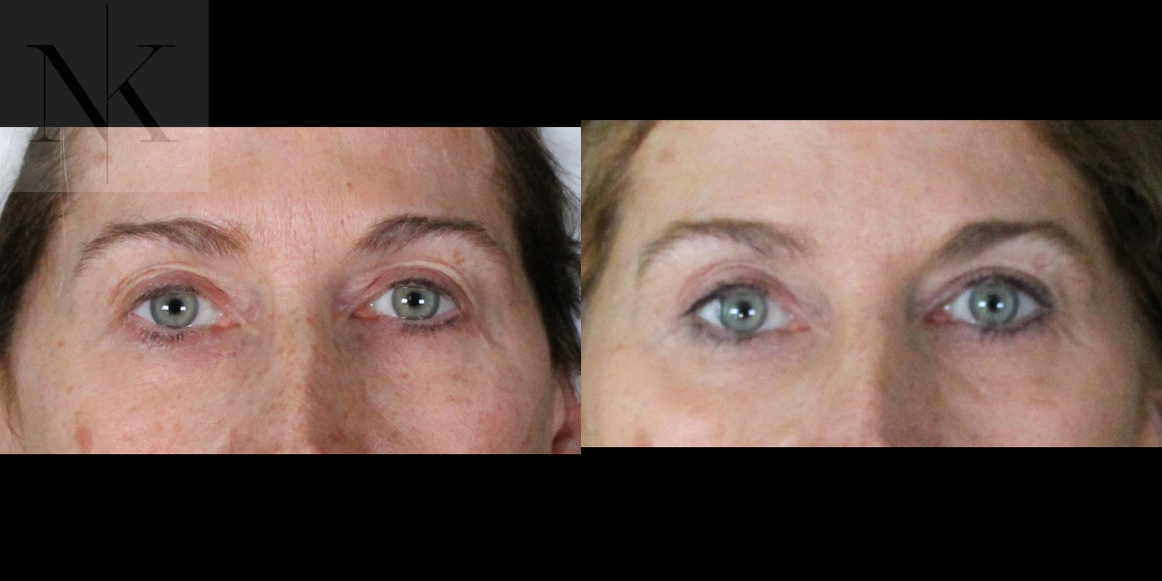 Before & After Upper Blepharoplasty Case 201 Front View in Wethersfield, Hartford, Nebraska
