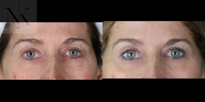 Before & After Upper Blepharoplasty Case 201 Front View in Wethersfield, Hartford, Nebraska