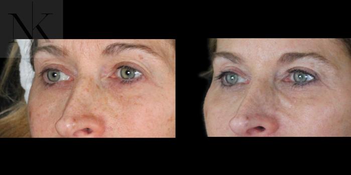 Before & After Upper Blepharoplasty Case 201 Left Oblique View in Wethersfield, Hartford, Nebraska