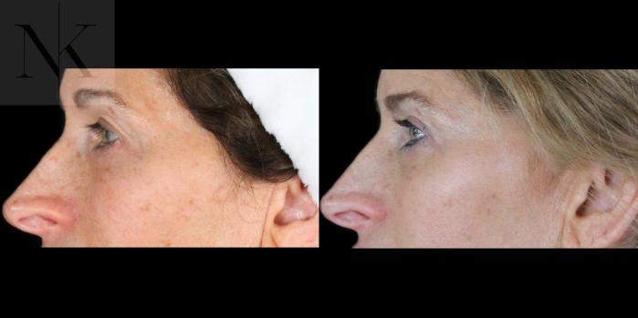 Before & After Upper Blepharoplasty Case 201 Left Side View in Wethersfield, Hartford, Nebraska