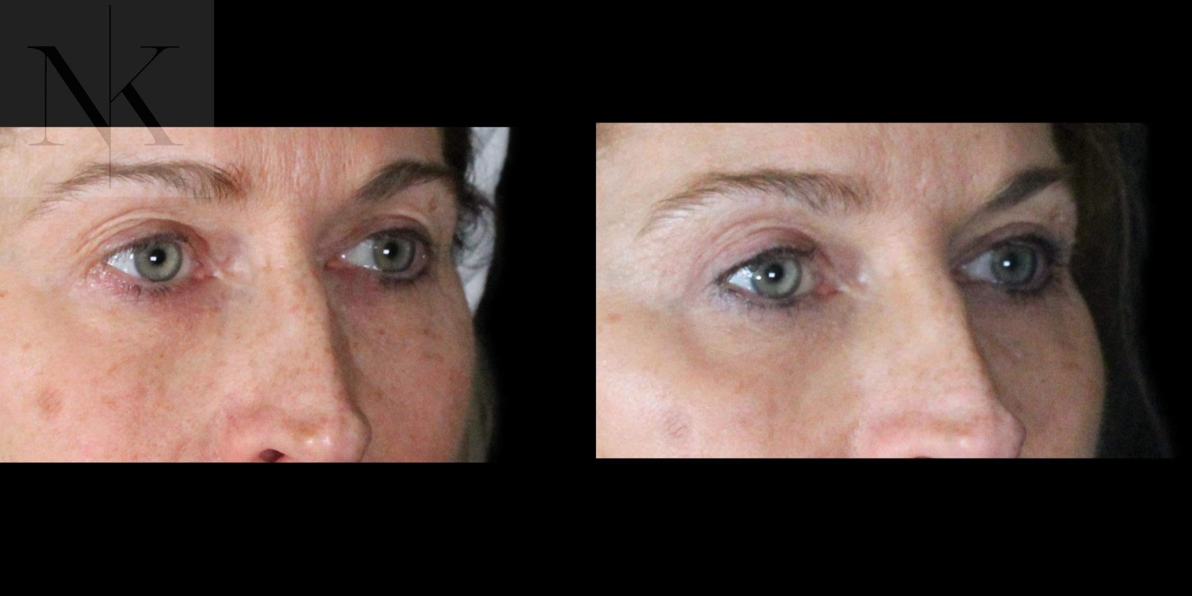 Before & After Upper Blepharoplasty Case 201 Right Oblique View in Wethersfield, Hartford, Nebraska