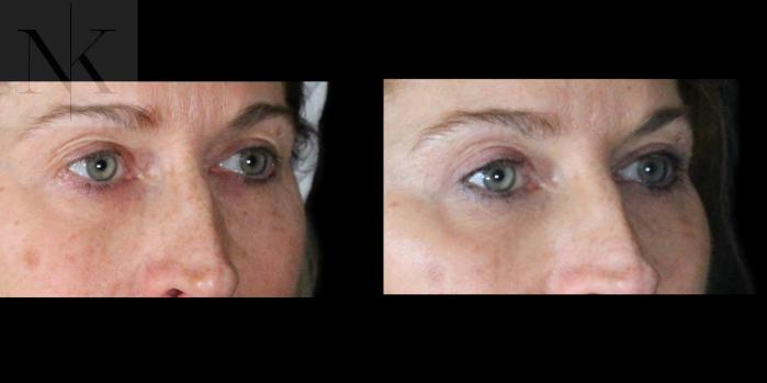 Before & After Upper Blepharoplasty Case 201 Right Oblique View in Wethersfield, Hartford, Nebraska