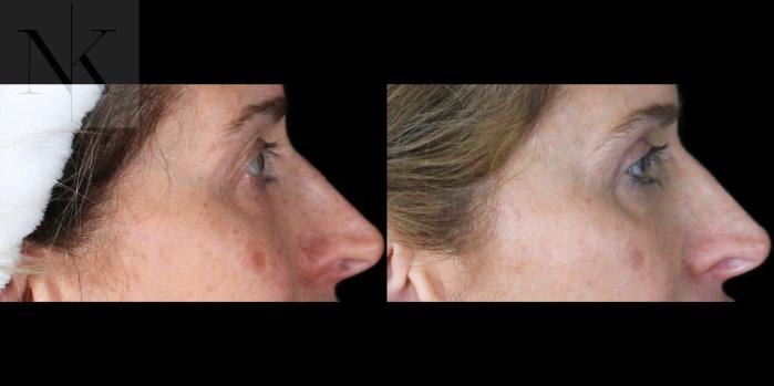 Before & After Upper Blepharoplasty Case 201 Right Side View in Wethersfield, Hartford, Nebraska